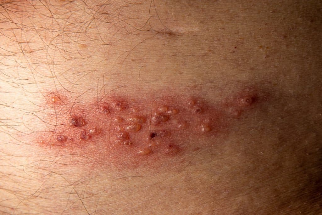 zona, zona zooster, vzv virus